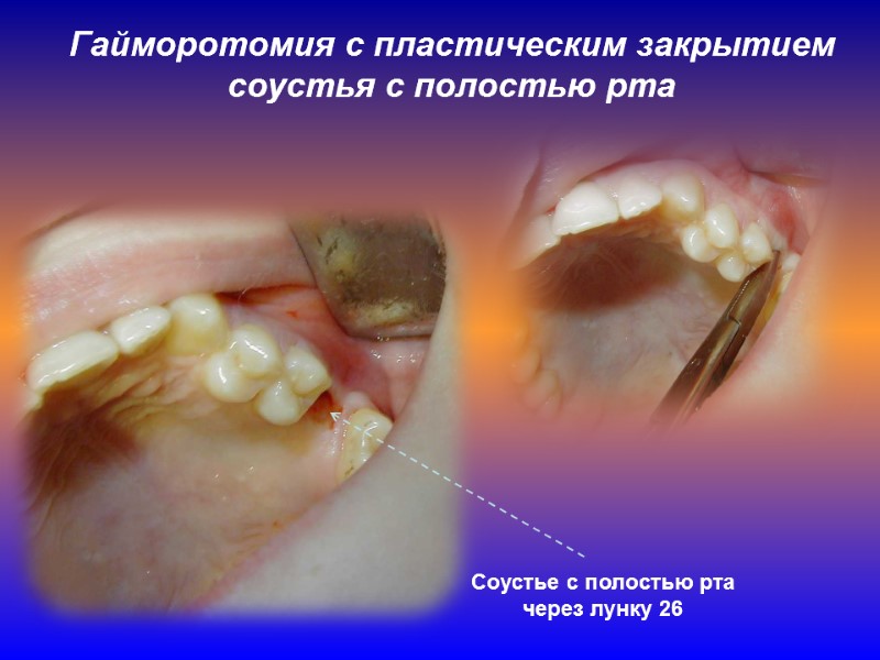 Гайморотомия с пластическим закрытием соустья с полостью рта Соустье с полостью рта через лунку